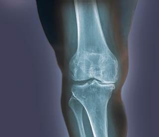 ozone relieves knee pain