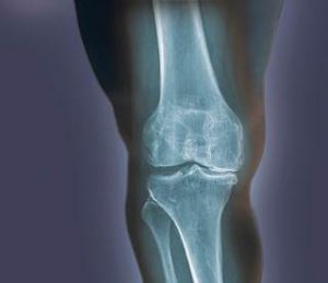 ozone relieves knee pain